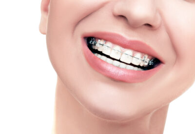 pros and cons of ceramic braces