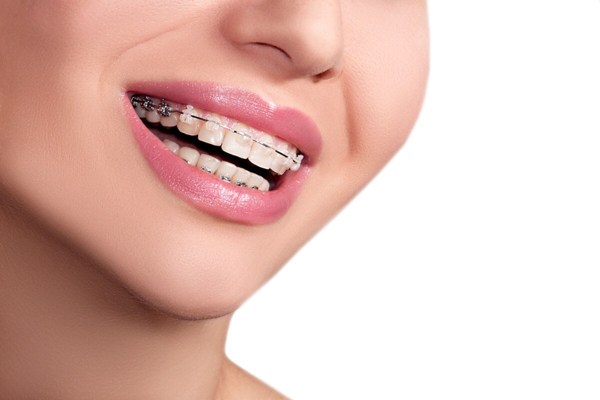 how do metal and ceramic braces work