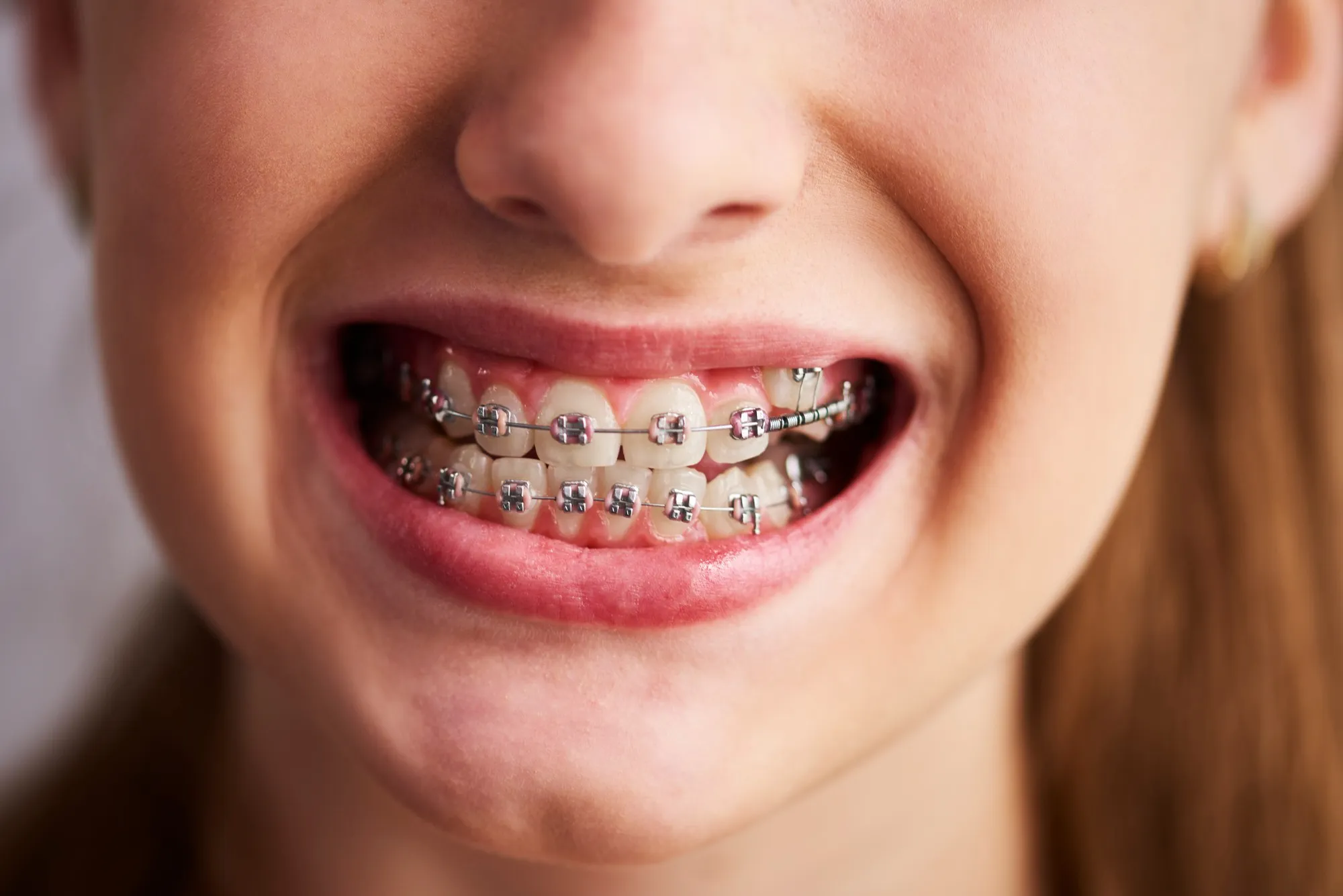 How Long Does It Take to Adjust to Braces Pain?